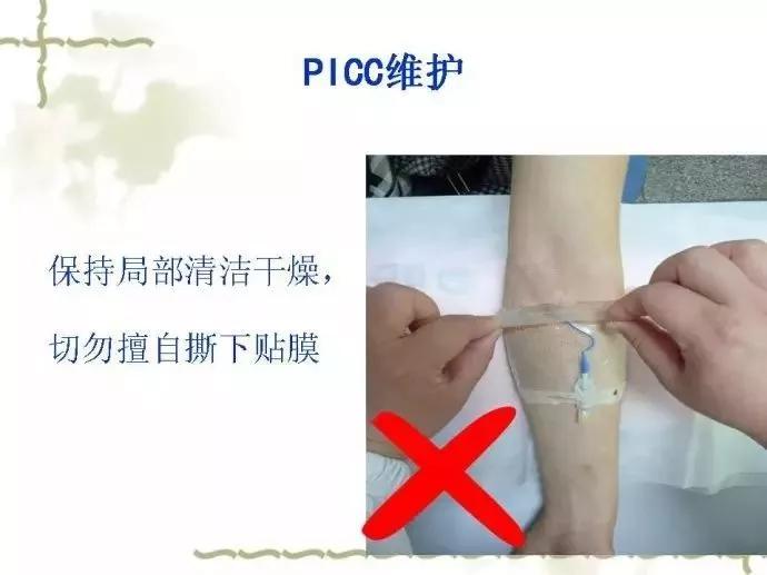 picc导管,不知道这些你还敢乱拔!