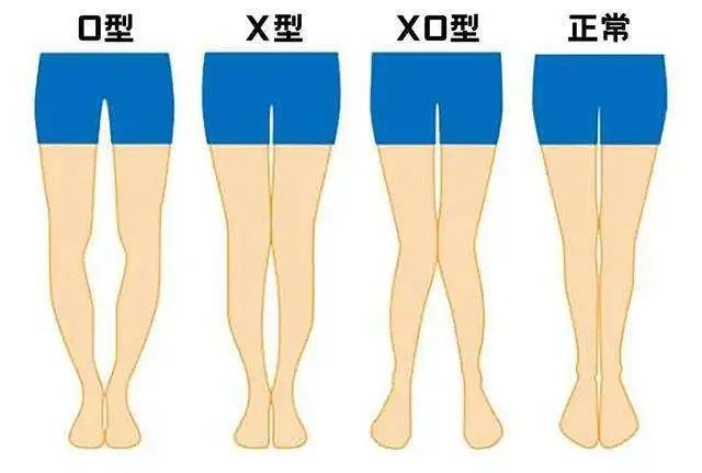 o型腿和x型腿不但有碍美观,影响某些动作的完成,甚至会造成膝关节疼痛