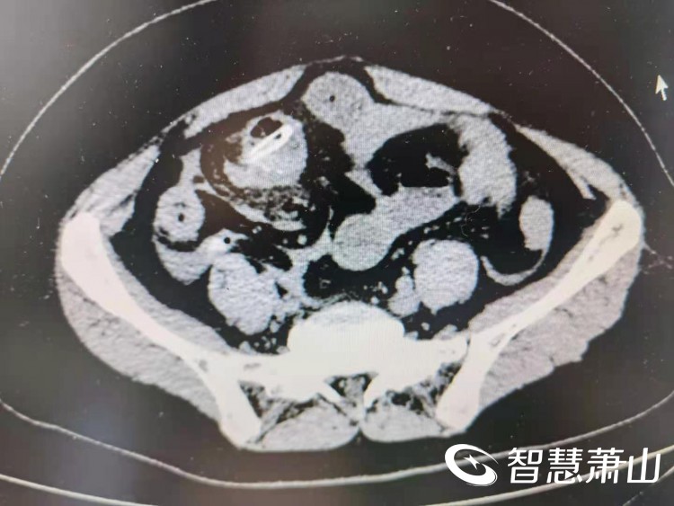 误食红枣核,竟导致肠穿孔