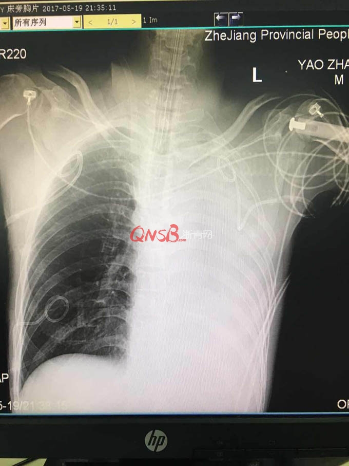 杭州一男子胸部遭貨車輪碾壓斷了12根肋骨,醫生都說驚心動魄