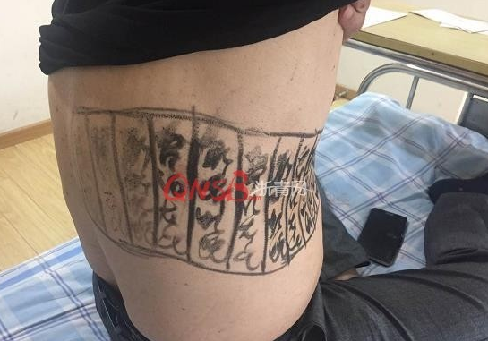 萧山一大伯为治带状疱疹,竟请大仙在身上画符!结果疼进医院