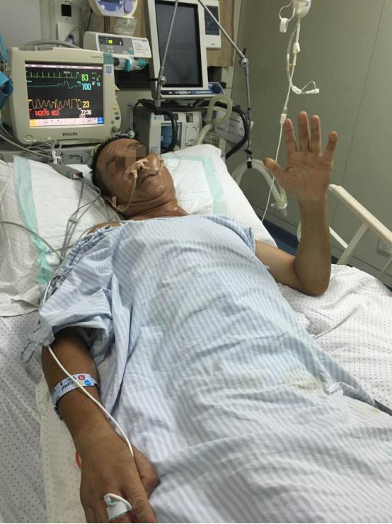 二期手术顺利,被两根钢筋穿透胸腹的男子恢复情况良好