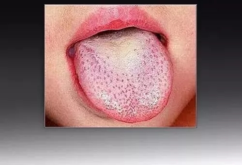 此外,猩红热发病,孩子的舌头表面可出现草莓般(呈红色和凹凸)的外观