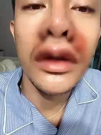 因长得太丑找不到工作,男子整容30多次!